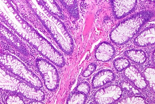 Histopathological study: showing an edematous appearance of the intestinal mucosa with inflammatory lymphocytes and histiocytes.