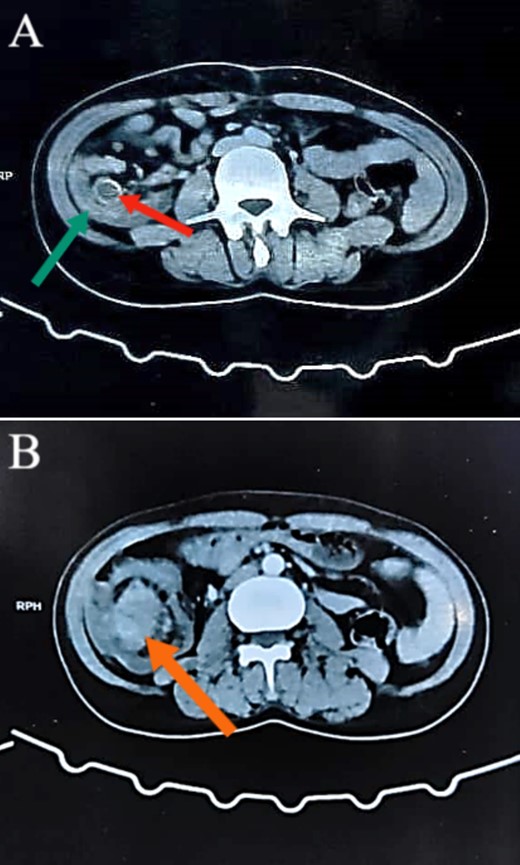 Abdominal CT images illustrating the presence of a concentric lesion in the cecum and proximal portion of the ascending colon, involving the terminal ileum. In (A), the red arrow indicates the terminal ileum within the cecal lumen, and the green arrow indicates the cecal wall (target sign). In (B), the orange arrow indicates the mass.