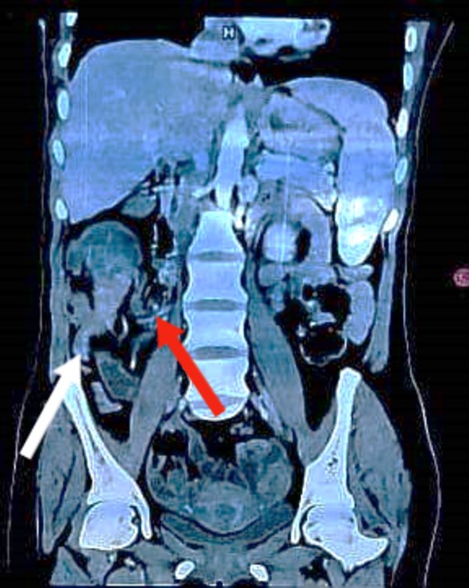 Coronal CT image demonstrating the lesion with the terminal ileum mesentery inside the cecum. The white arrow indicates the inflamed appendix. The red arrow indicates the terminal ileum and its mesentery entering the cecum.