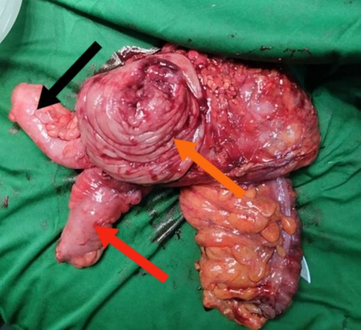 Surgical specimen post-block resection of the distal portion of the ileum and proximal portion of the ascending colon. The orange arrow indicates the mass with the intussusception. The red arrow indicates the terminal ileum. The black arrow indicates the appendix.