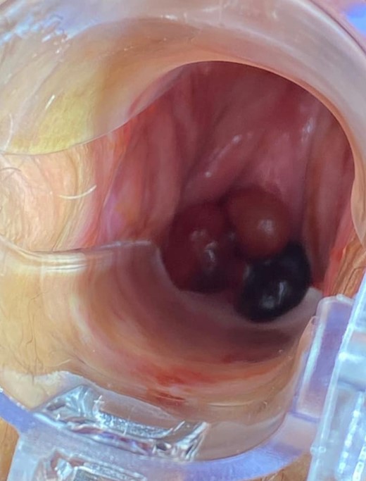 Speculum examination revealing a lobulated oval-shaped, firm mass occupying a substantial portion of the vaginal cavity.