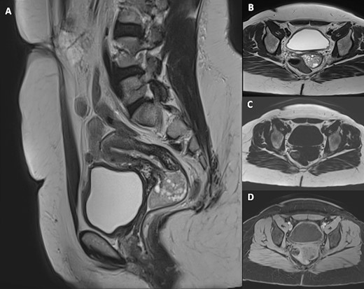 Pelvic MRI including sagittal T2-weighted (A), axial T2-weighted (B), axial T1-weighted (C) and axial post-Gadolinium injection (D) images, demonstrating a 5 cm × 3 cm × 3 cm intravaginal mass with endocervical implantation. The mass is well defined, featuring a slightly lobulated oval shape. It exhibits the same signal as the endometrium: isointense on T1-weighted images, moderate hypersignal T2 intensity, containing areas of marked hyperintensity on T2 with slight enhancement after Gadolinium injection.