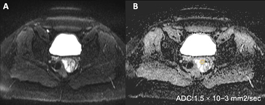 Pelvic MRI on Diffusion sequence and ADC mapping reveals no diffusion restriction, indicated by an elevated ADC value of (1.5 × 10)–3 mm2/s, suggesting benignity.