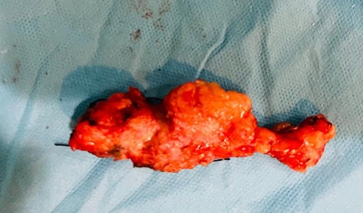 Macroscopic view of the polypectomy specimen, measuring 5 cm with a lobulated surface and firm consistency.
