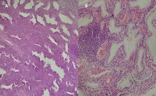 Histological examination of the excised specimen with Hematoxylin–Eosin staining at ×10 magnification (A) and ×40 (B) revealing endometrial glands of variable size and shape, often dilated and cystic, lined by a regular pseudostratified cylindrical epithelium. The stroma is cytogenetic with hemorrhagic changes, without signs of dysplasia or malignancy.