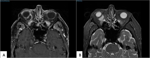 (A) T1 MR Orbits, and (B) T2 MR Orbits shows an intraconal mass measuring 16 × 8 × 15 mm in the inferonasal quadrant abutting the wall of the globe in the right orbit.