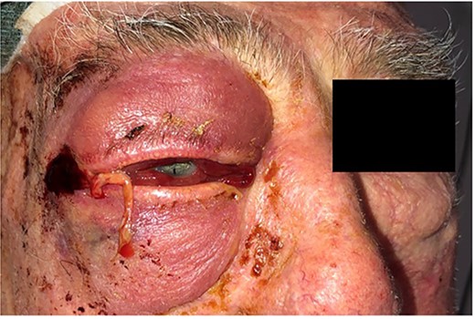 Appearance of right eye orbital compartment syndrome secondary to acute progression of the orbital abscess.
