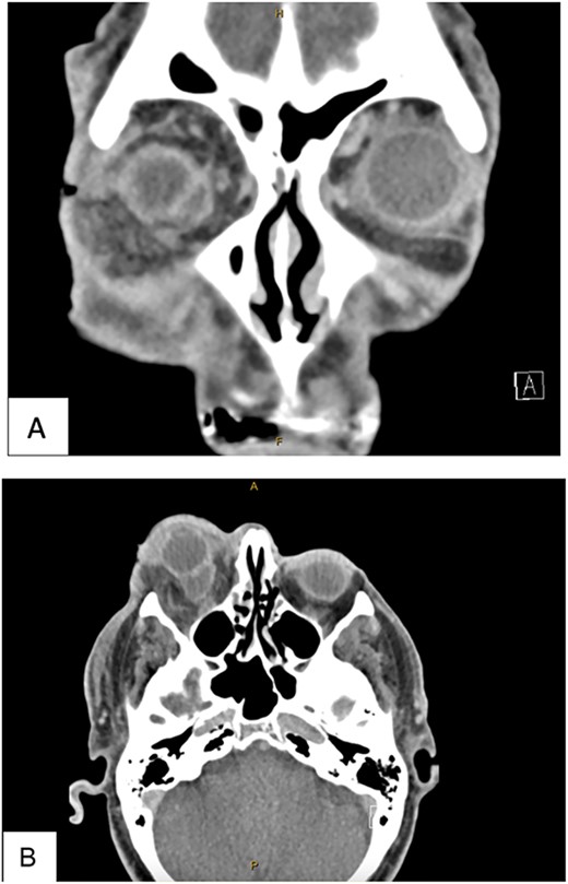 This CT was taken post lateral canthotomy. (A) CT Head with Contrast Coronal View. (B) CT Head with contract axial view. Both views show an 11 × 15 × 14 mm peripherally enhancing collection abutting the posteroinferior aspect of the right globe. There is associated retrobulbar fat stranding. There is thickening and enhancement of the lateral rectus muscle. The right optic nerve sheath shows enhancement but no signs of effusion.