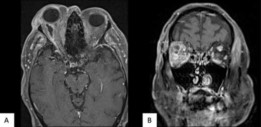 Axial (A) and coronal (B) MRI T1 FS post contrast imaging demonstrating new, right sided posterosuperior, peripherally enhancing collection post drainage of previous collection.