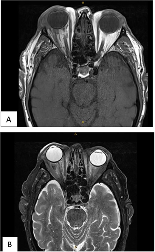 (A) MR Orbit T1 TSE R TRA. (B) MR Orbit T2 FS TSE TRA. The right lateral retroorbital abscess has reduced in size. The traction on the optic nerve has reduced.