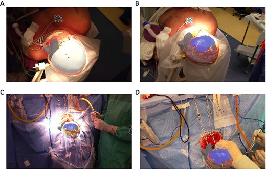 (A, B) Surgeons view through the AR headset displaying the 3D model overlaid on the patient from Case 1 preoperatively and (C, D) intraoperatively showing vasculature, hematoma, ventricles, and skull. Virtual trajectories are placed by surgeon to indicate a planned burr hole location.