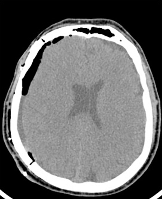 Postoperative CT imaging from Case 1.