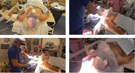 Surgeon’s view through the headset displaying the 3D model registered into the patients’ head from Case 2 showing hematoma, brain, skull, ventricles. Surgeon used AR display to mark incision and craniotomy location.