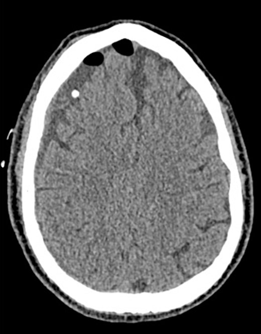 Postoperative CT imaging from Case 2.
