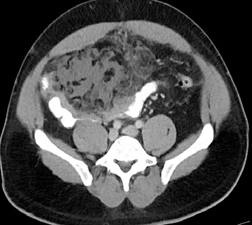 CT finding of OI with focal omental edema and inflammation overlying small bowel wall edema.