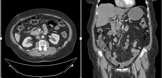 CT abdomen and pelvis with IV contrast with axial and coronal views demonstrating the Pancreatic mass.