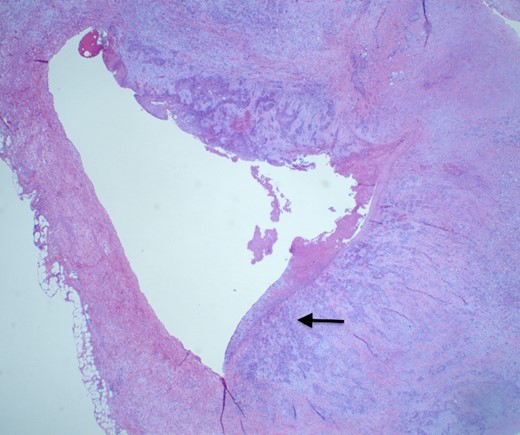 H&E slide demonstrating SMV invasion