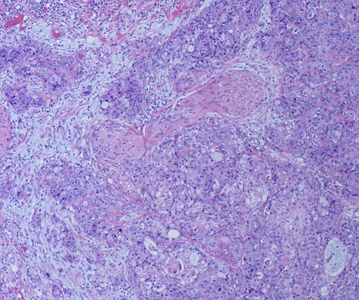 H&E Slide demonstrating perineural invasion