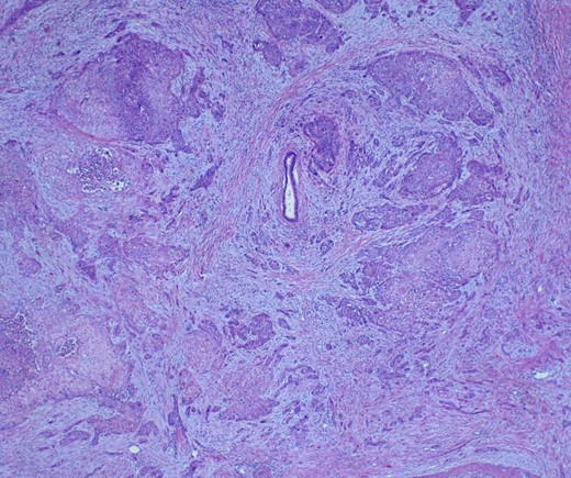 Adenosqumous carcinoma with both components (adeno and squamous) A19 Cytokeratin 7 immunostain, highlighting the adenocarcinoma, and p40 immunostain, highlighting the squamous carcinoma component