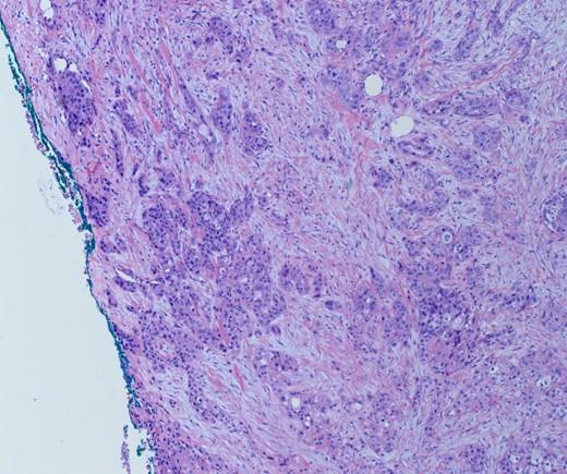 H&E slide demonstrating superior mesenteric artery invasion