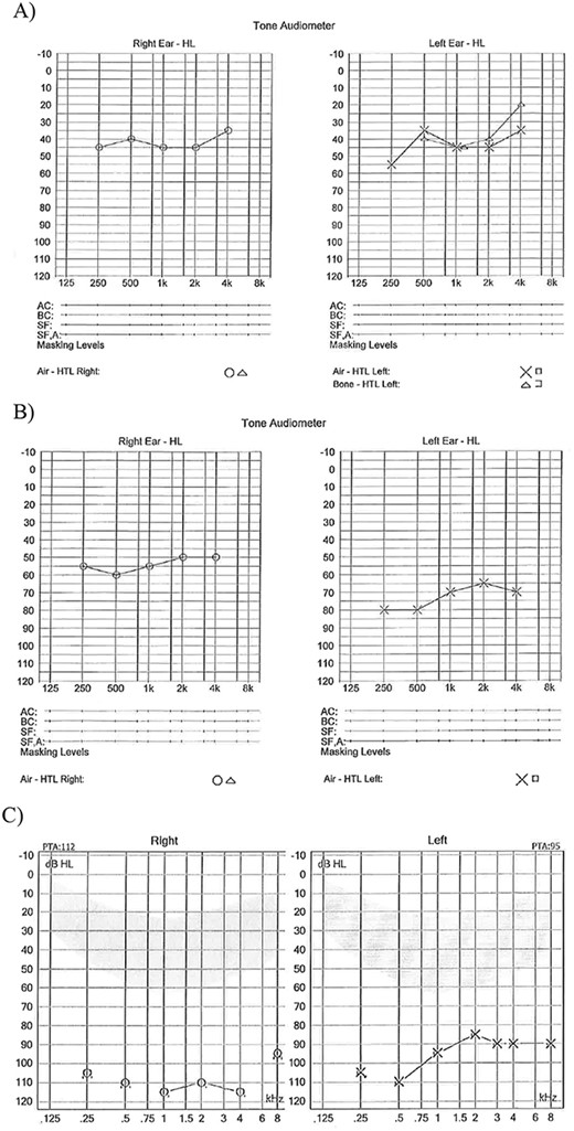 (A) Age 8 mild to moderate HL both ears; (B) Age 11 years moderate HL right ear and severe HL left ear; (C) Age 14 years profound HL both ears.