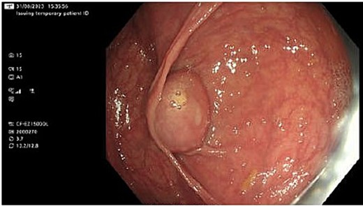 Mass at the appendiceal orifice similar to a mucocele.