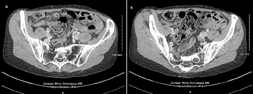 CT scan of the abdomen showing (A) 10 mm low attenuation lesion at the base of appendix and (B) mildly thick walled appendix containing a small volume of fluid.