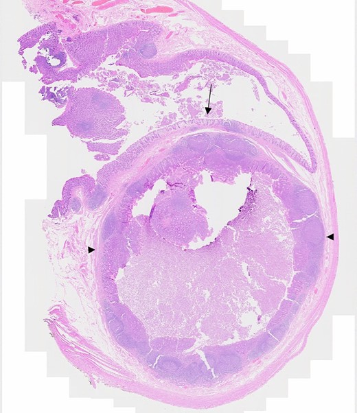 Microscopic section showing appendiceal diverticulum, Arrow: Caecal mucosa, Arrowheads: Submucosal lesion.