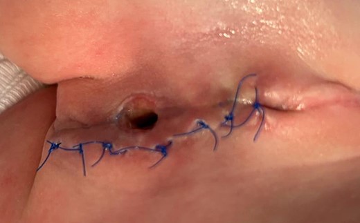 Postoperative esophago-cutaneous fistula.