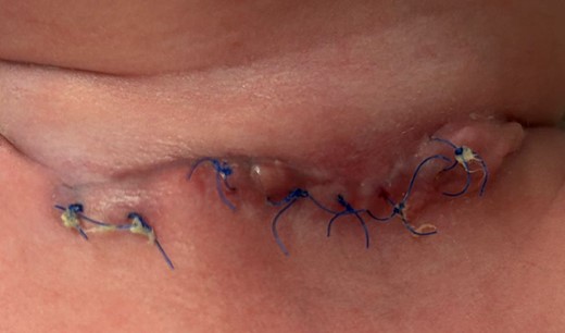 After 2 months of conservative management and advanced dressing.