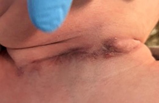 Wound healing.