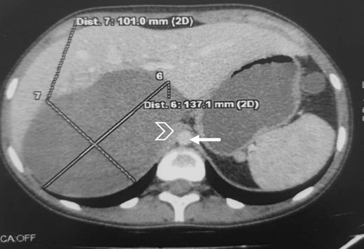 Large right retroperitoneal mass, hypodense, oval, well defined, with regular contours (arrow: aorta; arrowhead: IVC).