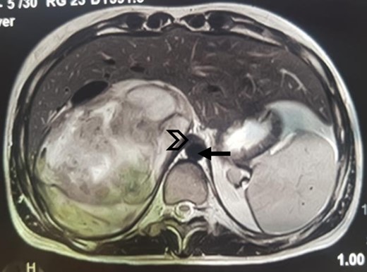 MRI, well-limited oval right adrenal mass, slightly heterogeneous mixed T2 signal (arrow: aorta; arrowhead: compressed IVC).