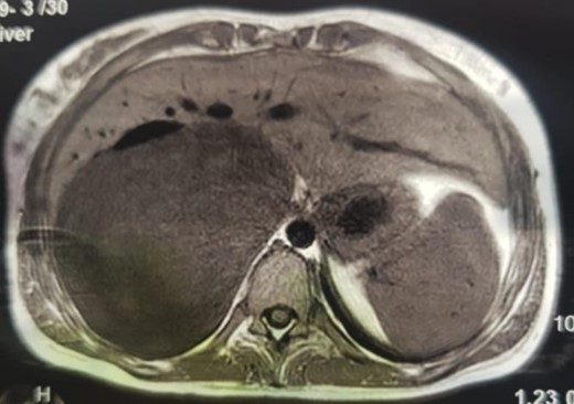 MRI, voluminous lesion of the right adrenal medulla in hyposignal T1.