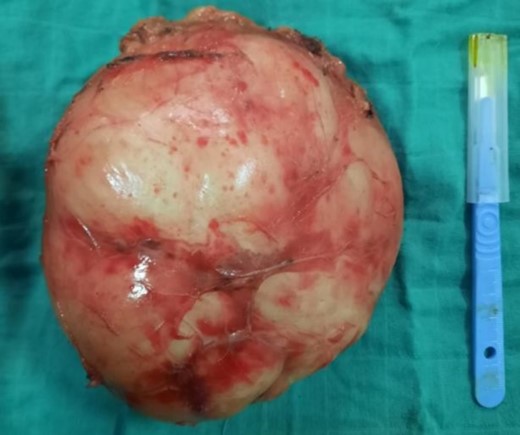 Adrenal piece, 14 × 13 × 9 cm3, 860 g, smooth, encapsulated surface