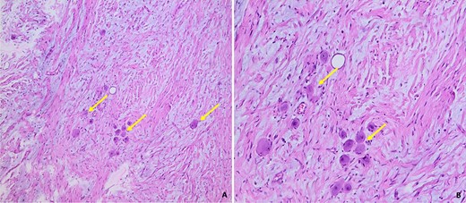 Histological images of our patient’s GN, showing a fusocellular proliferation of Schwanian-type cells with the presence of mature ganglion cells, isolated or grouped in piles (arrow). The stroma is fibrous and myxoid (Photo A: under standard coloration, enlargement x100) (Photo B: under standard coloration, enlargement x200).