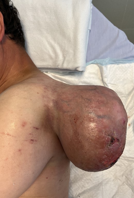 Giant soft tissue tumour on the left scapular region; initial signs of cutaneous pressure ulcers.