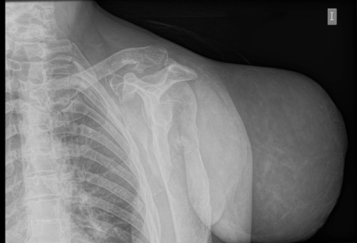 Simple radiography: evident soft tissue tumour on the left shoulder with multiple bone deformities compatible with osteochondromatosis.