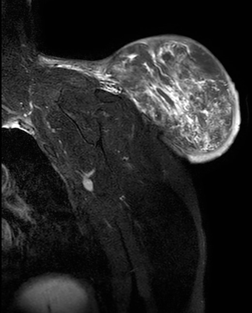 Magnetic resonance imaging T2 with contrast: giant excrescent lesion of 19 × 18 × 14.4 cm of diameter located in the subcutaneous tissue of the posterior aspect of the scapula divided by multiple septums; axillary lymph node of ~0.9 cm; images compatible with liposarcoma with a metastatic axillary lymph node.