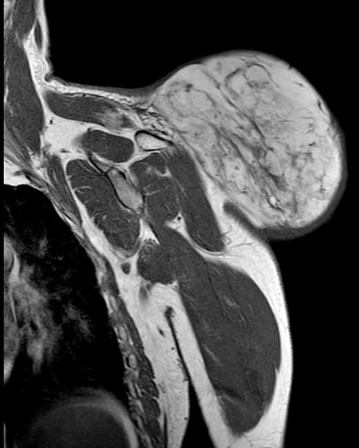 Magnetic resonance imaging T1: polylobulated lesion with multiple septa separating different areas of fat tissue.