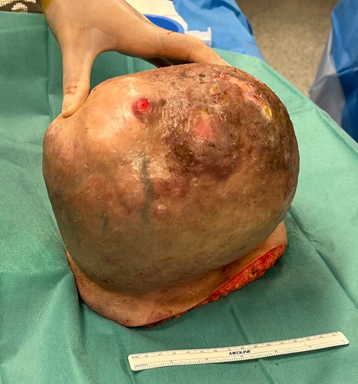 Macroscopic findings: solid lesion of 21 × 16 × 17cm of lipomatous characteristics with focus of fat necrosis compatible with PL.