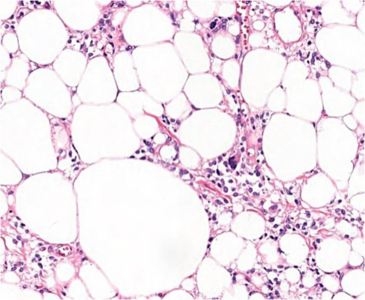 Microscopic findings (H & E ×40): well-circumscribed lesion at the profound dermis, composed of mature adipocytes, with occasional pleomorphic lipoblasts and spindle cells in the stroma some of which presented ‘floret’-like morphology; focal areas of necrosis and absence of mitotic activity; intense and diffuse response to CD34.