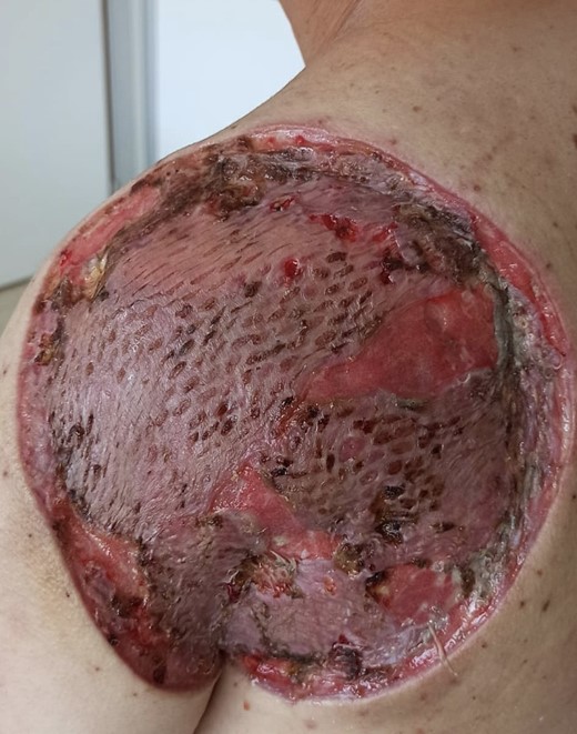 Skin graft after 3 week of the surgery; correct signs of healing, good vascularization, no necrosis.
