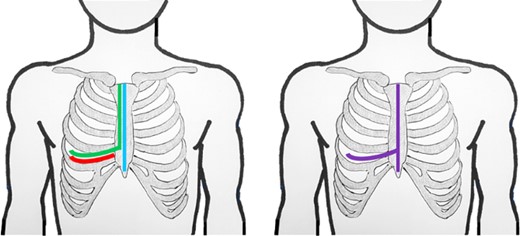 Schematic lines of incision for anterolateral thoracotomy (red); hemiclamshell (green); sternotomy (blue); T-incision (violet).