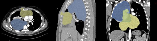 CT scan of tumor dimensions.