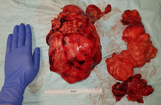 The two en bloc removed tumor specimens.