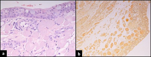 Histopathological assessment of conjunctival lesion. (a) Haematoxylin and eosin stain conjunctival mucosa with underlying globules of cellular eosinophil deposits. (b) Congo-red stain shows apple green birefringence under polarizing microscopy.