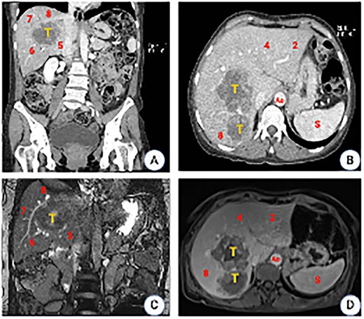 CT scan images. (A) Coronal plane showing the tumor location involving segments 5, 6, 7 and 8. (B) Axial plane showing the relation to the inferior vena cava (IVC). (C) MRI showing a liver mass with peripheral and heterogeneous central enhancement. (D) Axial MRI (T1phase). Ao, aorta; S, spleen.