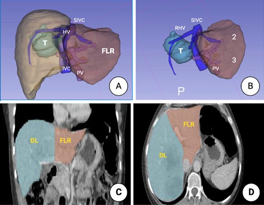 3D image reconstruction. (A) Right hemi-liver mass involving segments 5, 6, 7 and 8. The relation to the suprahepatic veins (HV), IVC and the PV is shown. (B) Future liver remnant (FLR) (Segments 2 and 3). SIVC, suprahepatic inferior vena cava; PV, portal vein; FLR, future liver remnant. (C) Liver volumetry. Coronal plane delimiting the transection line planned and the FLR. (D). Axial plane, showing the transection line planned and the FLR.
