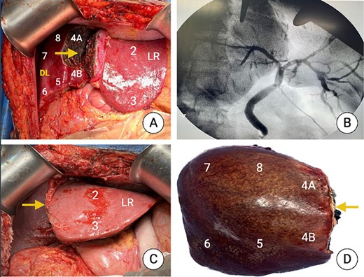 Intraoperative picture after the first stage (once completed the partial liver transection) and after the second stage. (A) Partial transection just to the right of the falciform ligament showing segments 2 and 3 (LR). (B) Intraoperative cholangiography. (C) Liver remnant (Segments 1, 2 and 3 at the end of the second stage). (D) Specimen after surgical removal showing the liver segments, and the transection plane (arrow).